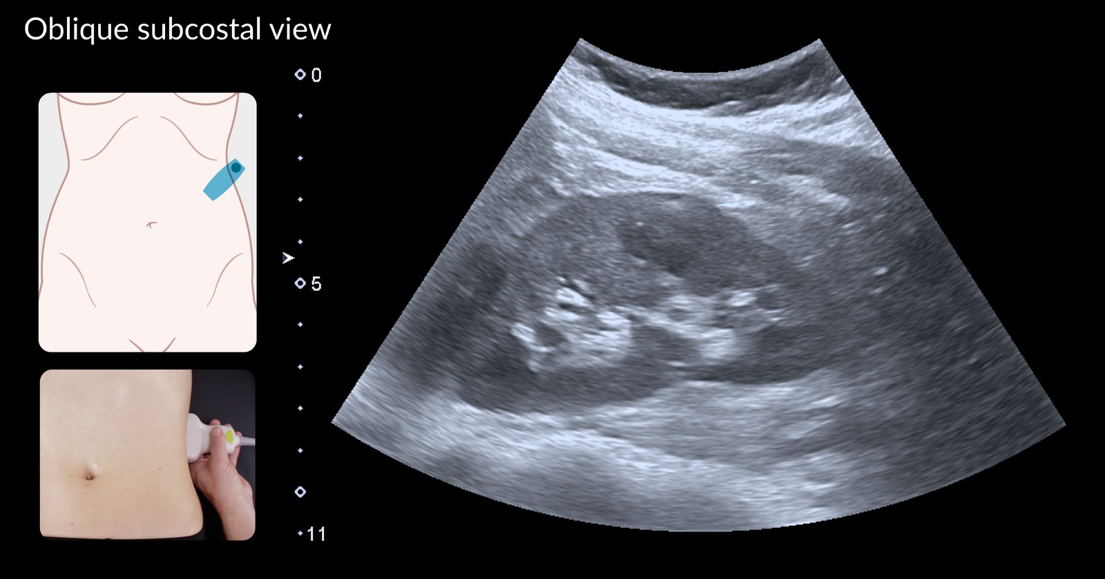 Normal ultrasound left kidney