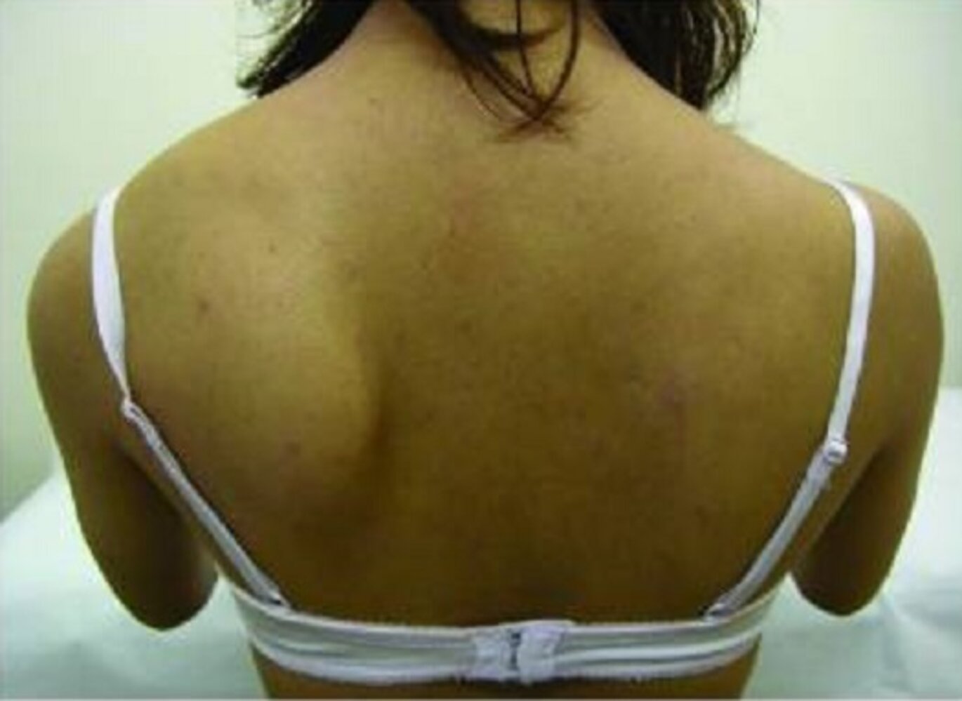 Medial winging of the scapula