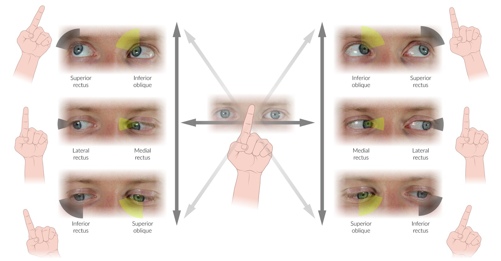 Clinical testing of the extraocular muscles