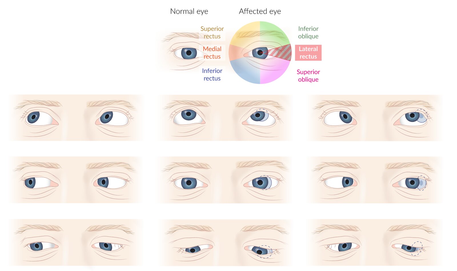 Abducens nerve palsy