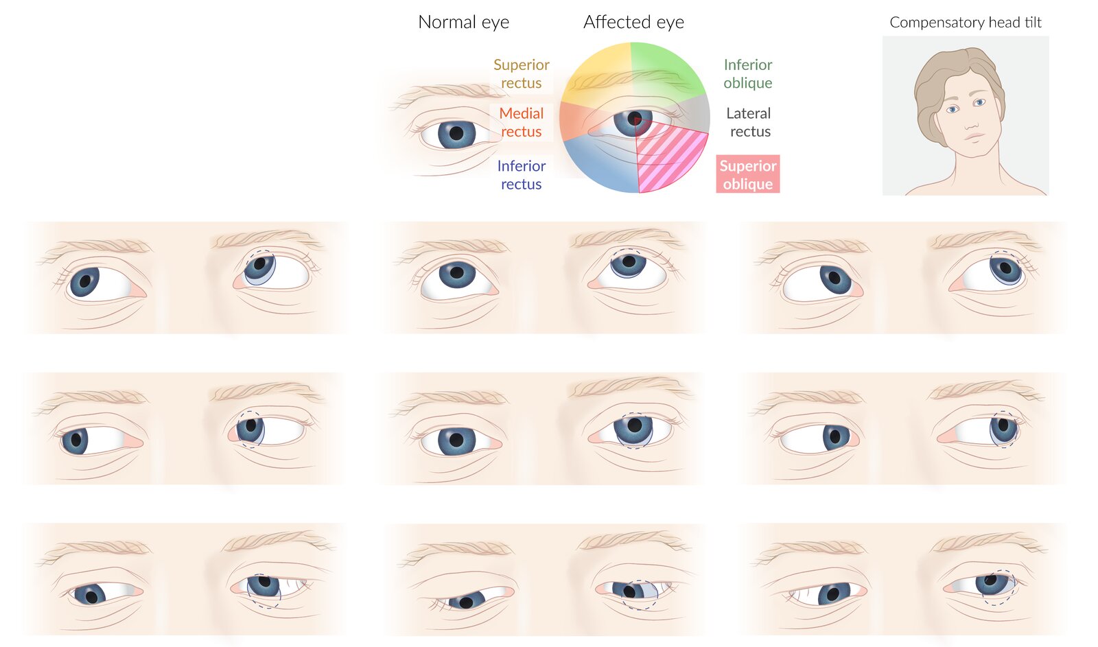 Trochlear nerve palsy