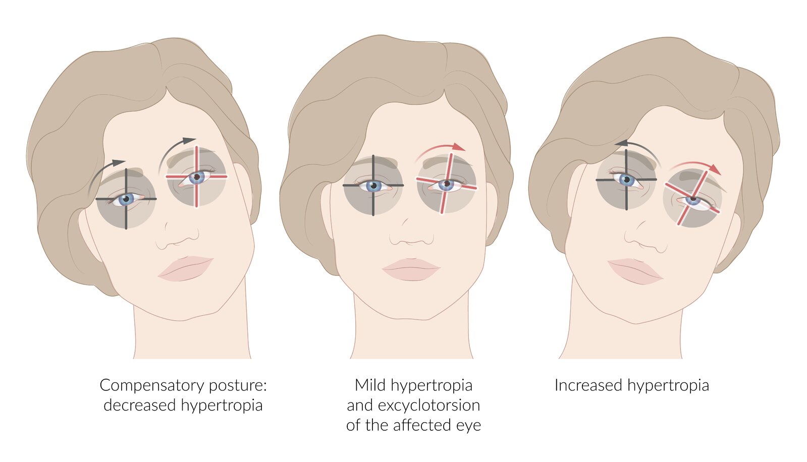 Trochlear nerve palsy