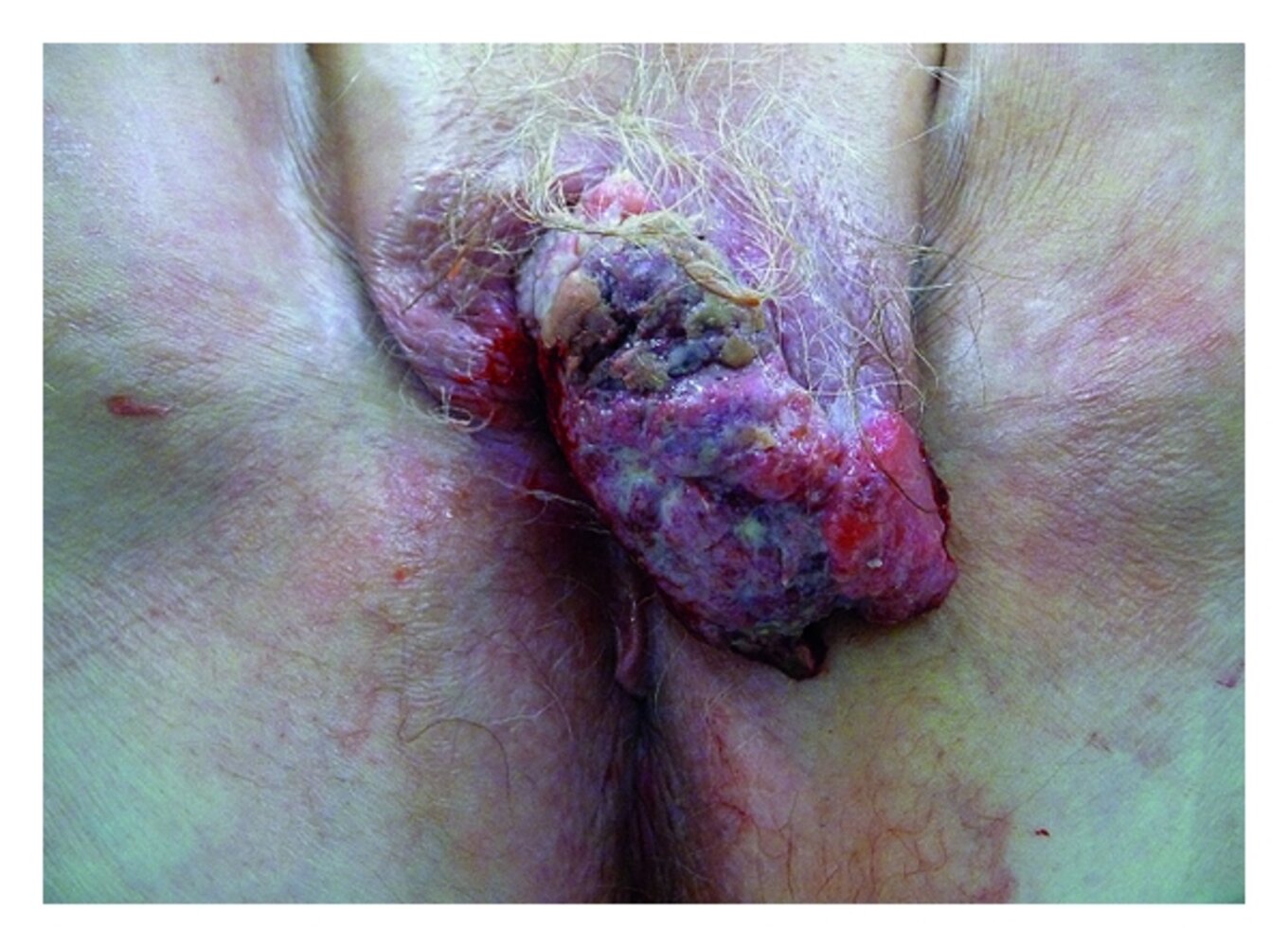 Vulvar squamous cell carcinoma