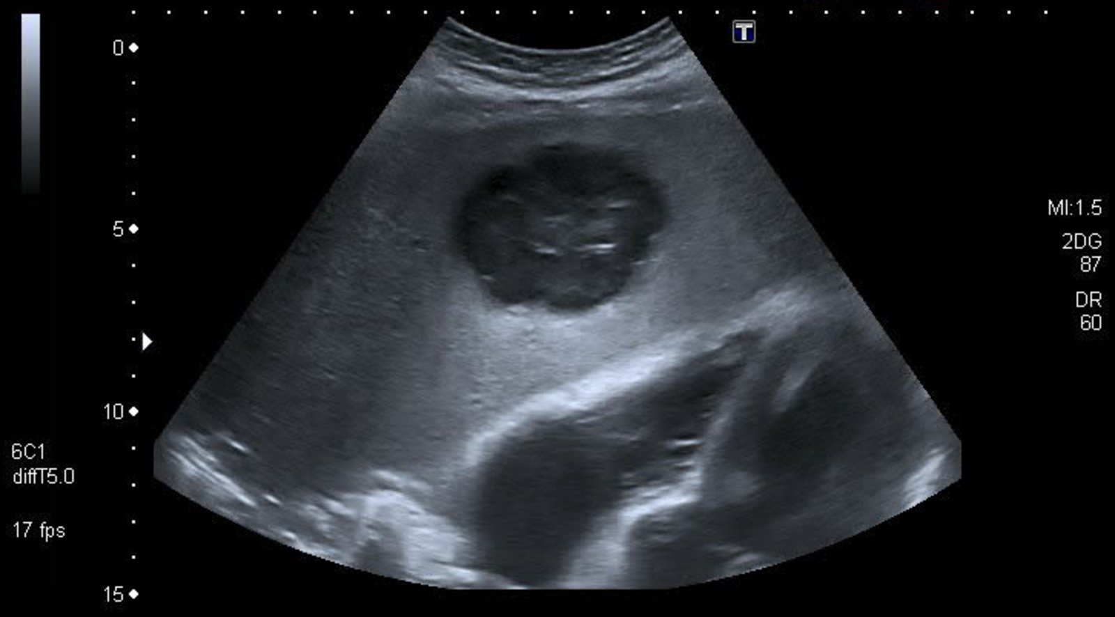 Mixed echogenicity liver mass