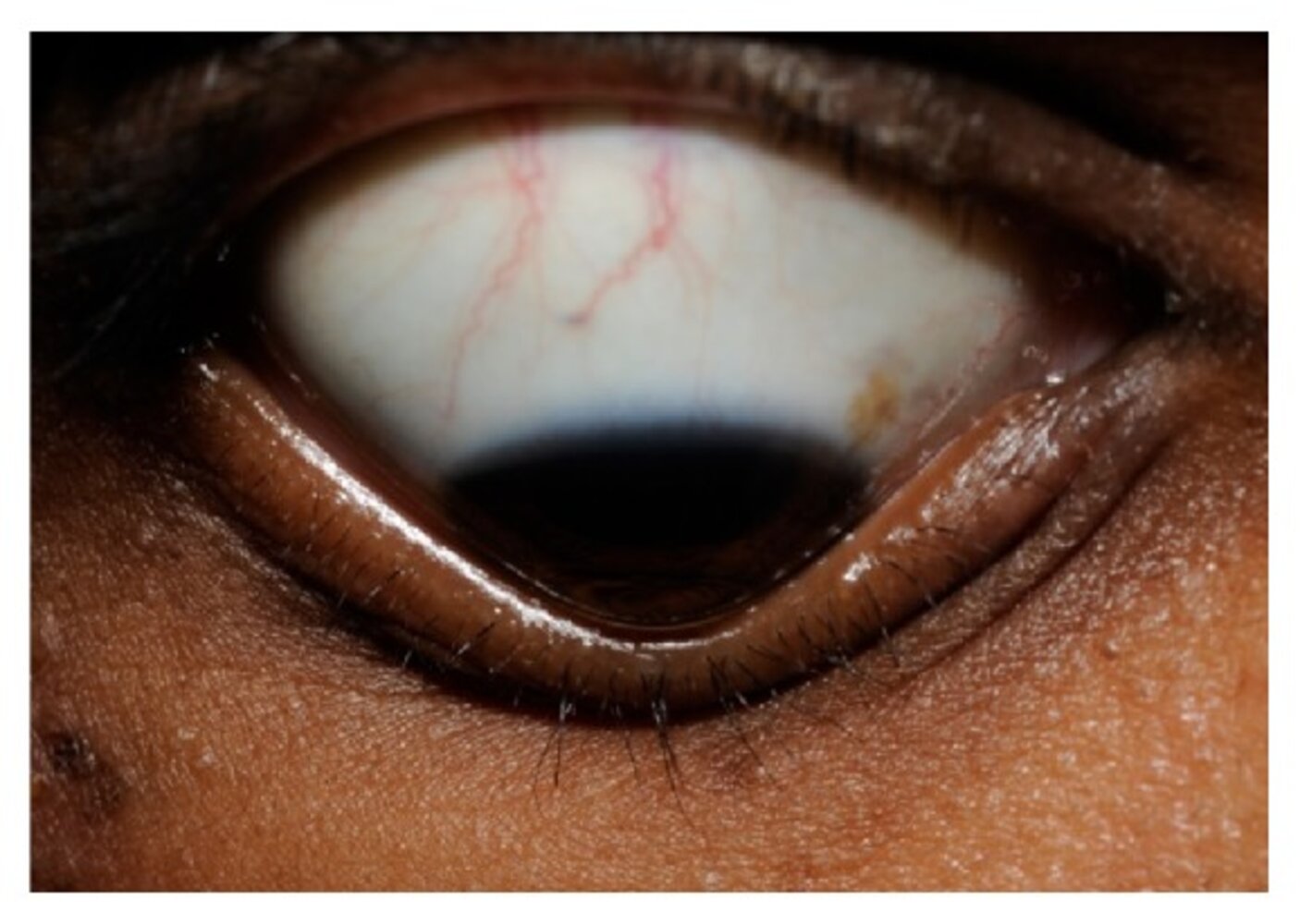 Keratoconus