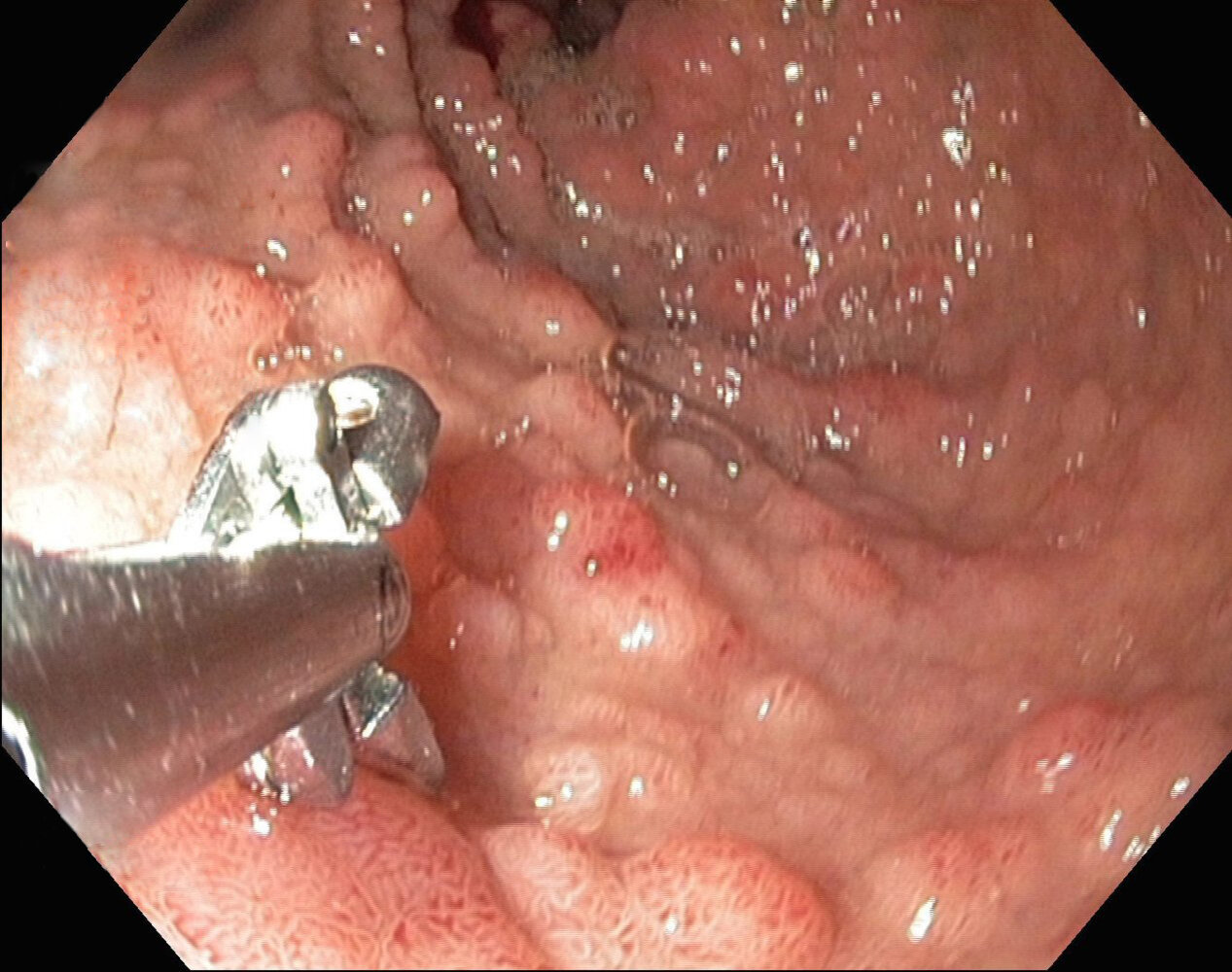 MALT lymphoma of the small intestine