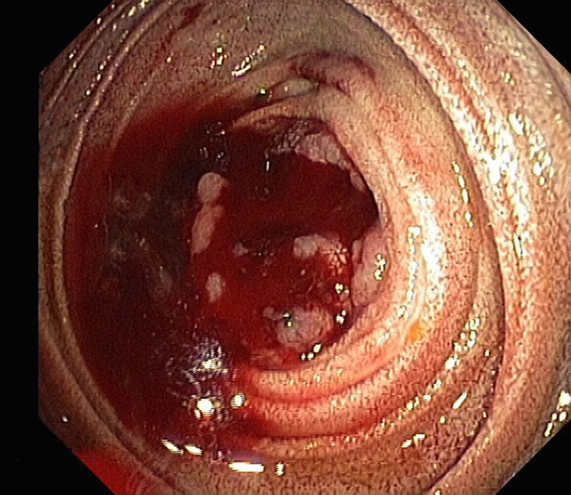 Tumor in the small intestine