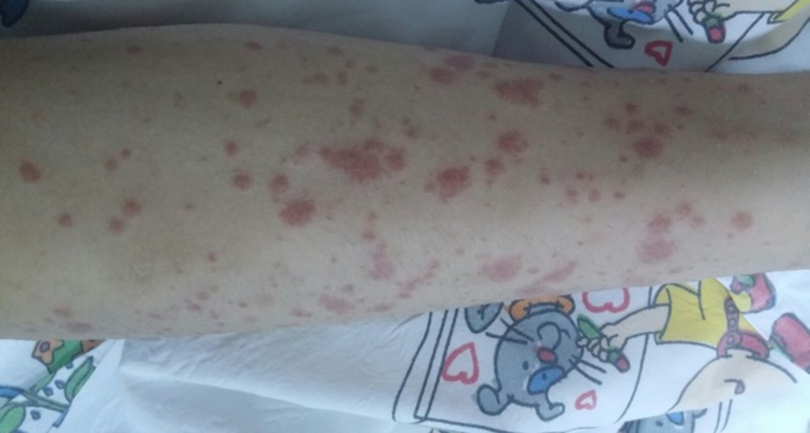 Purpura in IgA vasculitis