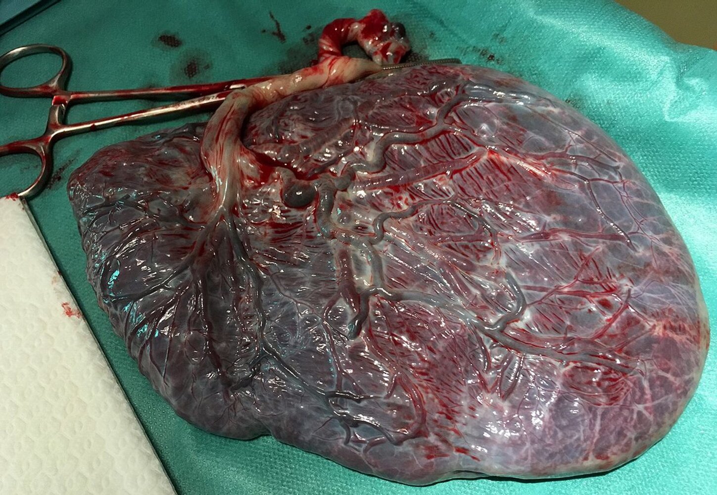 Placenta (fetal side)
