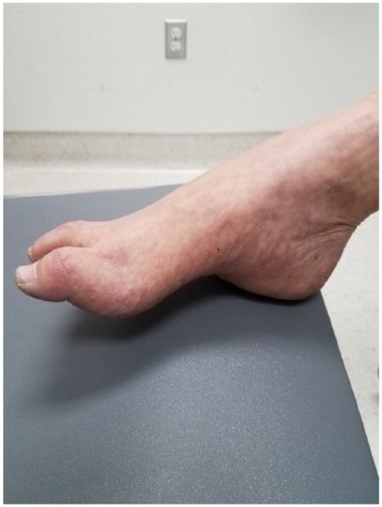 Pes cavus and hammer toes