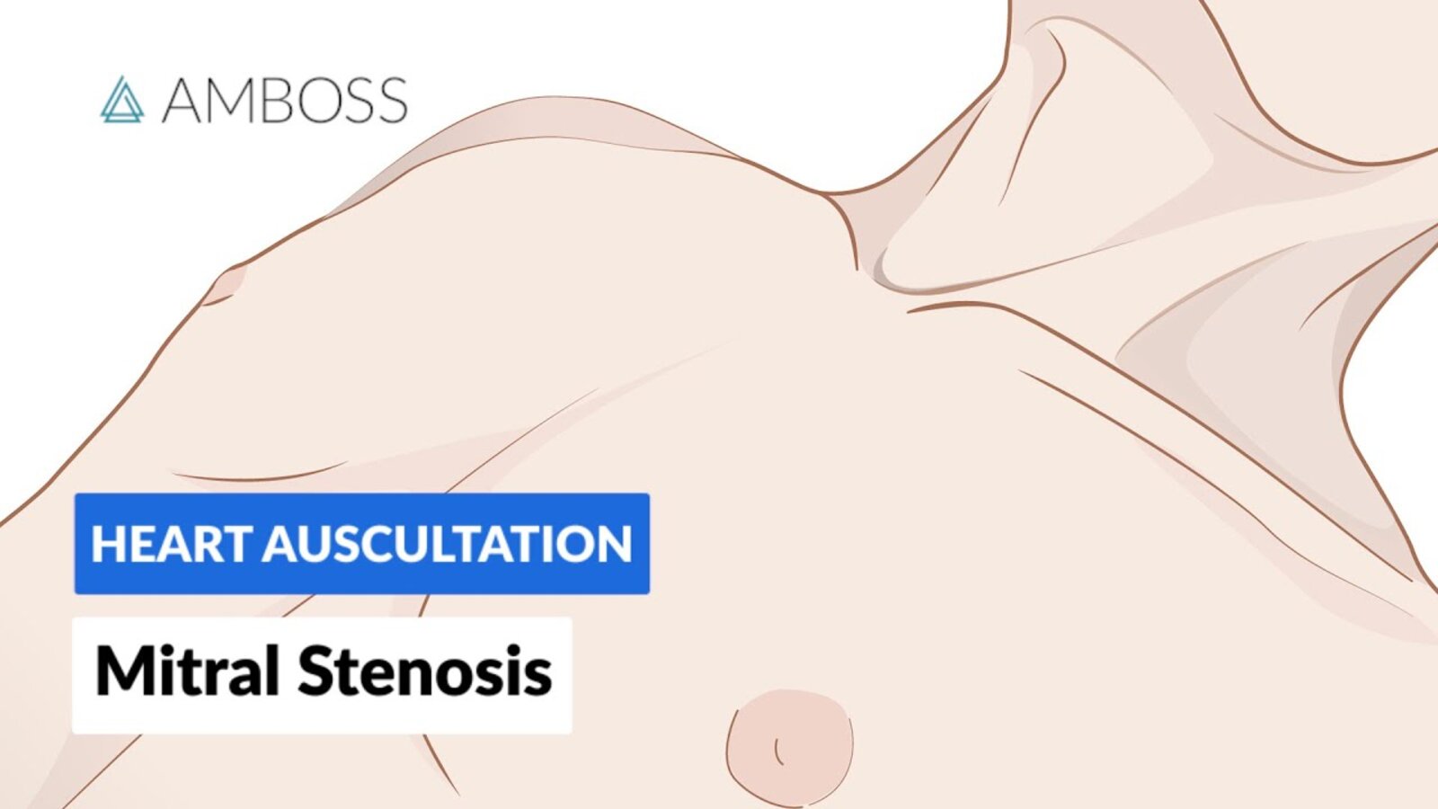 Mitral Stenosis (MS) - Heart Auscultation - Episode 3