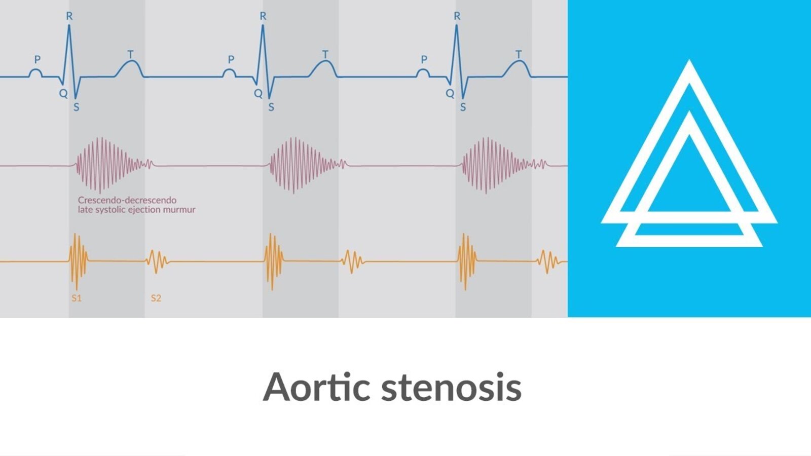 Aortic stenosis - Heart Murmur - Clinical examination | Δ AMBOSS