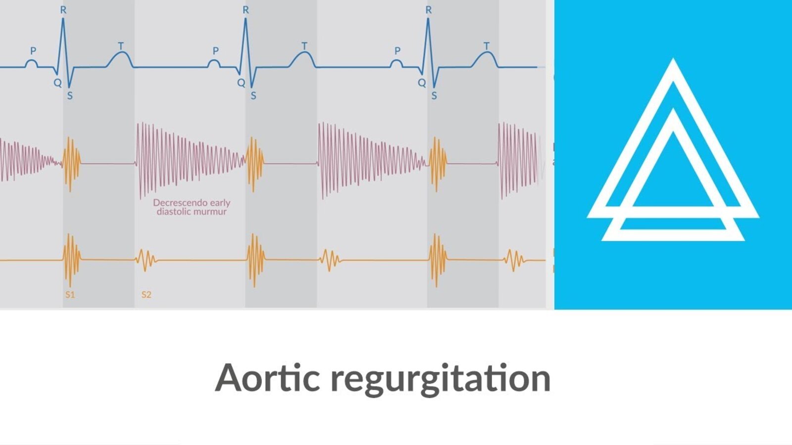 Aortic regurgitation - Heart murmur -  Clinical examination | Δ AMBOSS