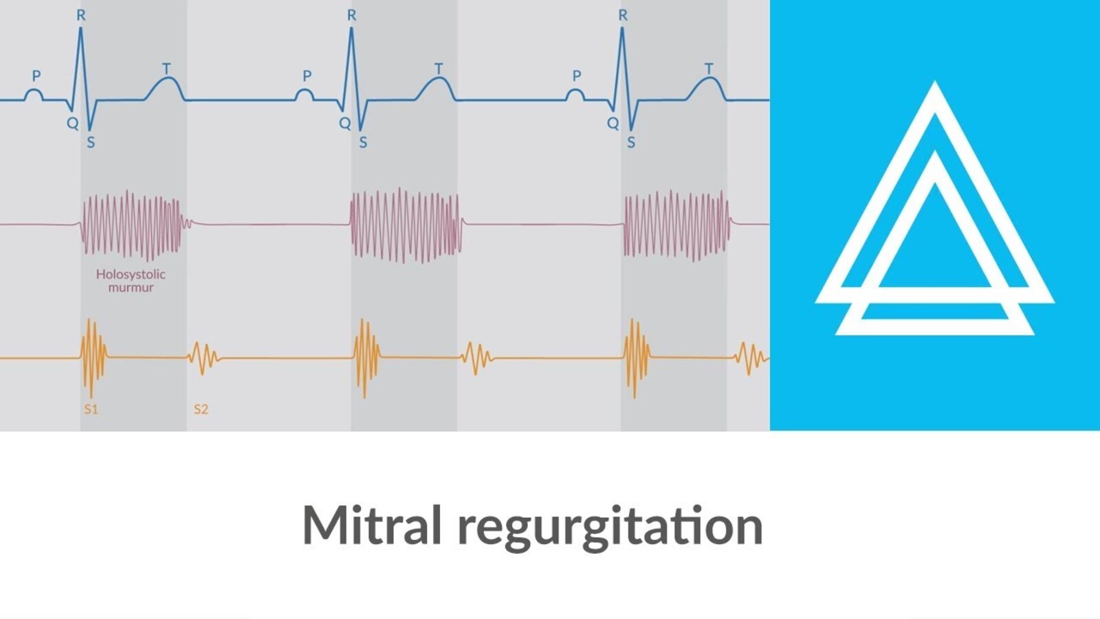 Mitral regurgitation - Heart murmur - Clinical examination | Δ AMBOSS