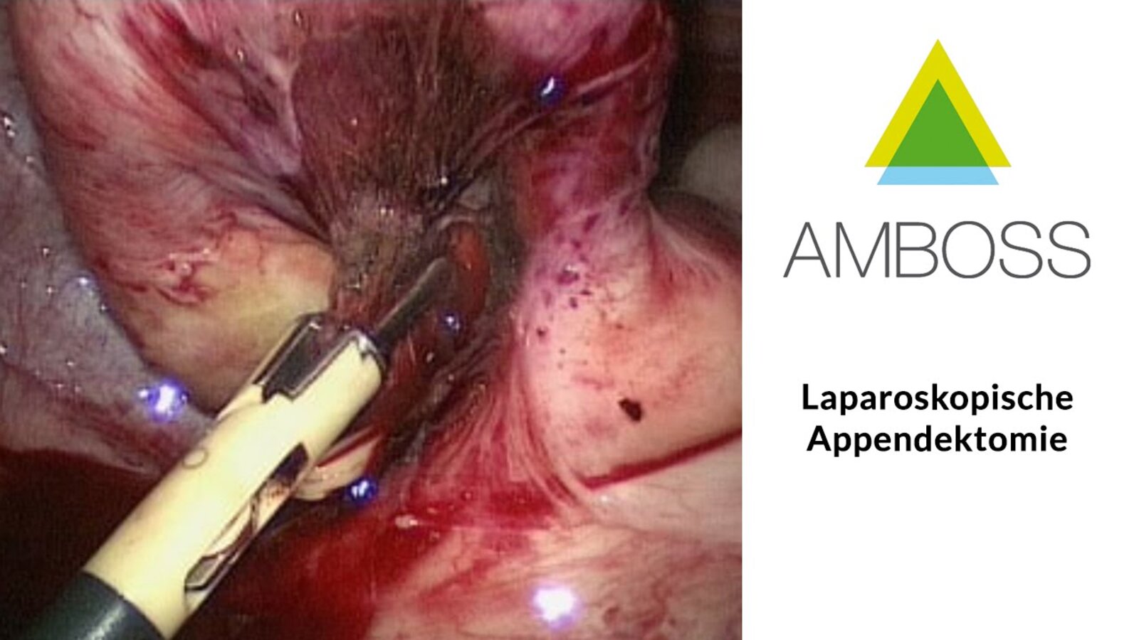 Laparoscopic appendectomy operation