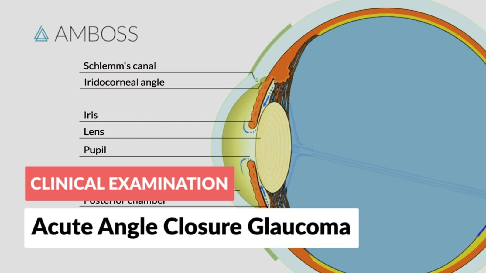 Acute Angle Closure Glaucoma