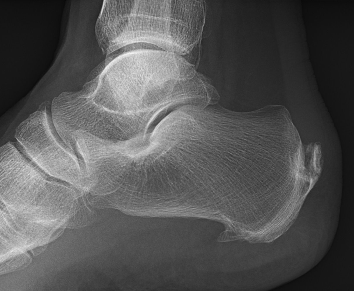 Achilles and plantar calcaneal spurs