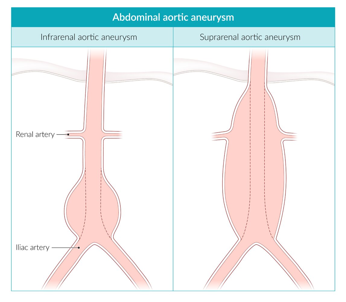 Abdominal aortic aneurysm locations