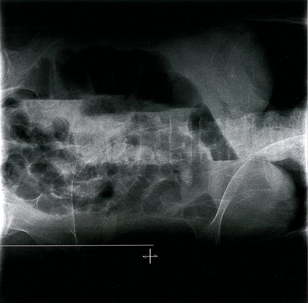 Paralytic ileus from mesenteric ischemia