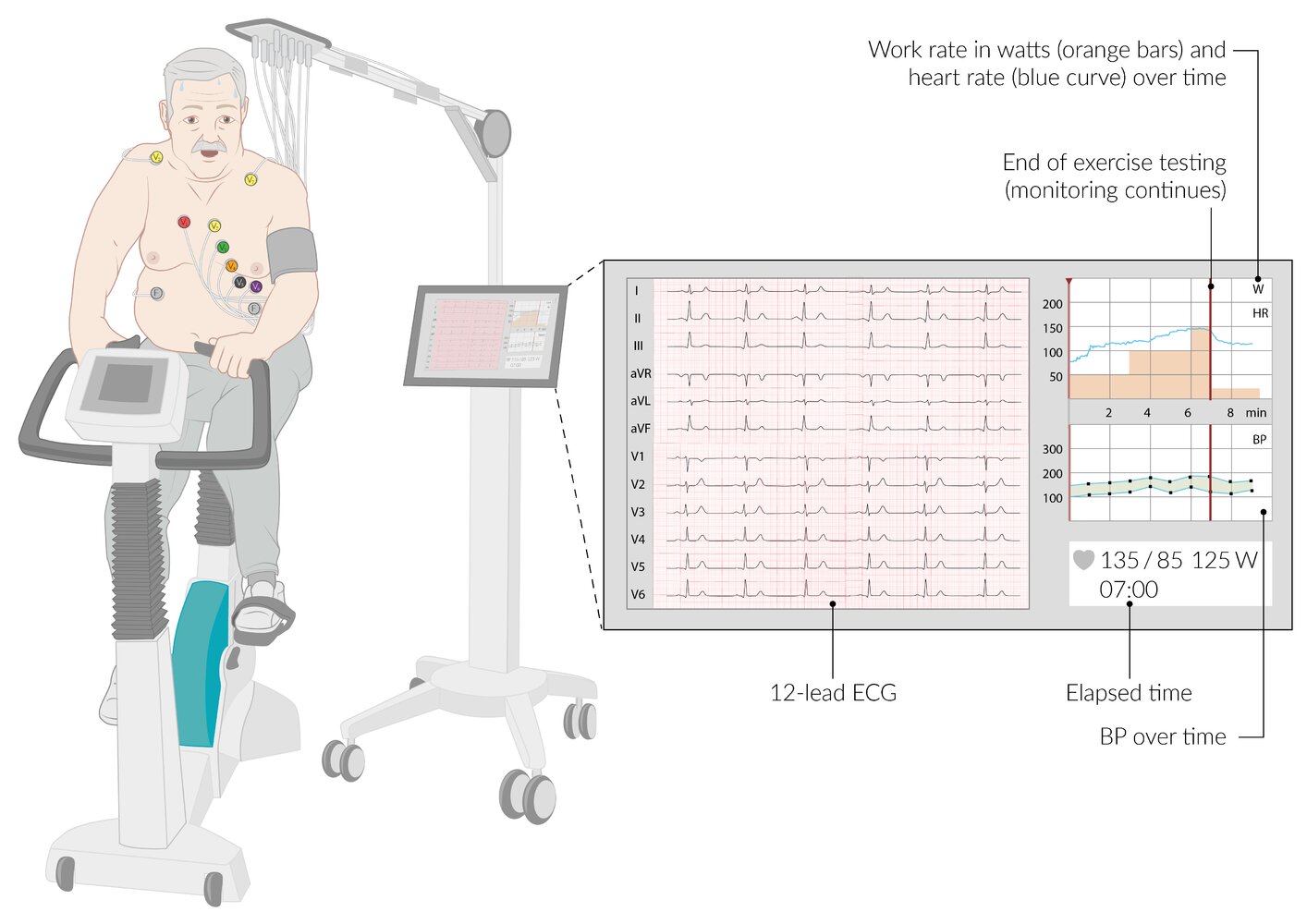Exercise ECG testing (stationary bicycle)
