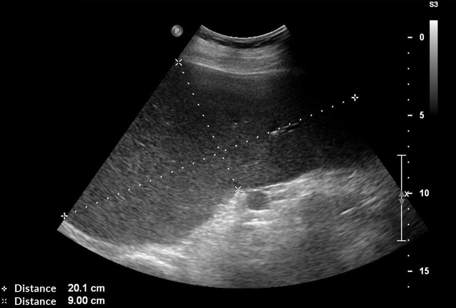 Splenomegaly