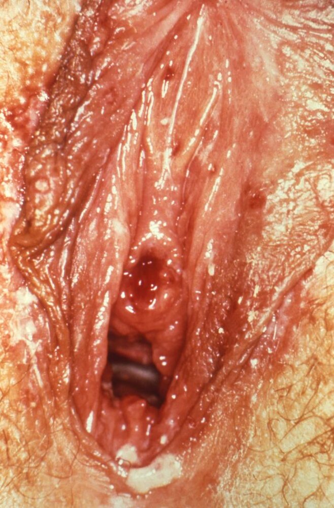Genital herpes