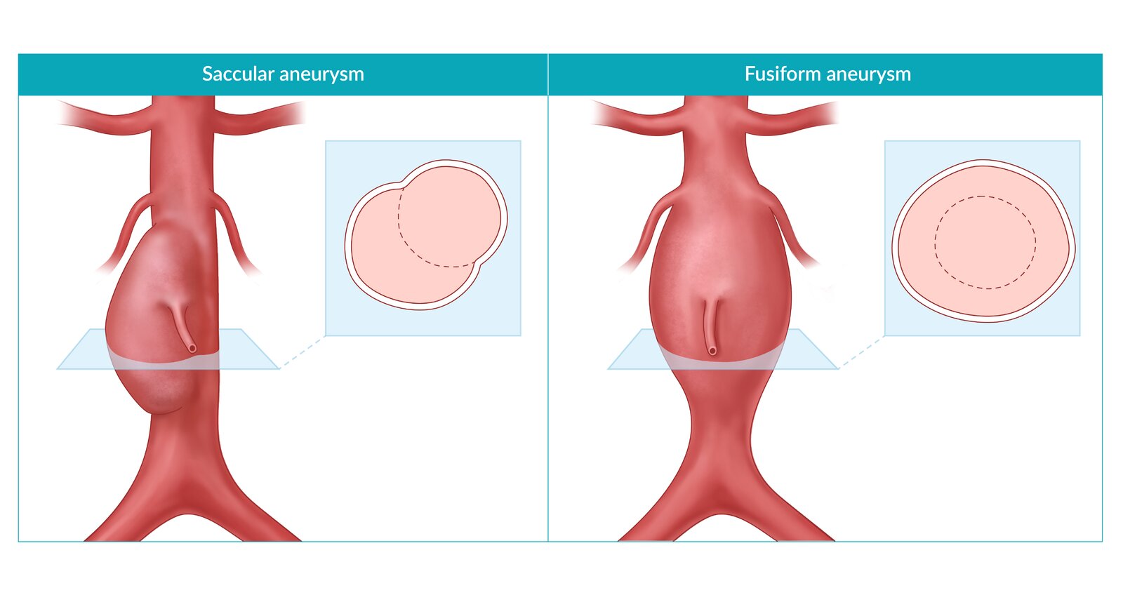 Saccular and fusiform abdominal aortic aneurysms