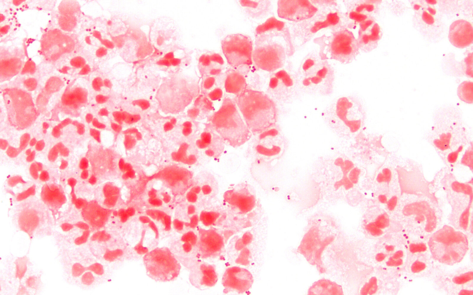Neisseria meningitidis