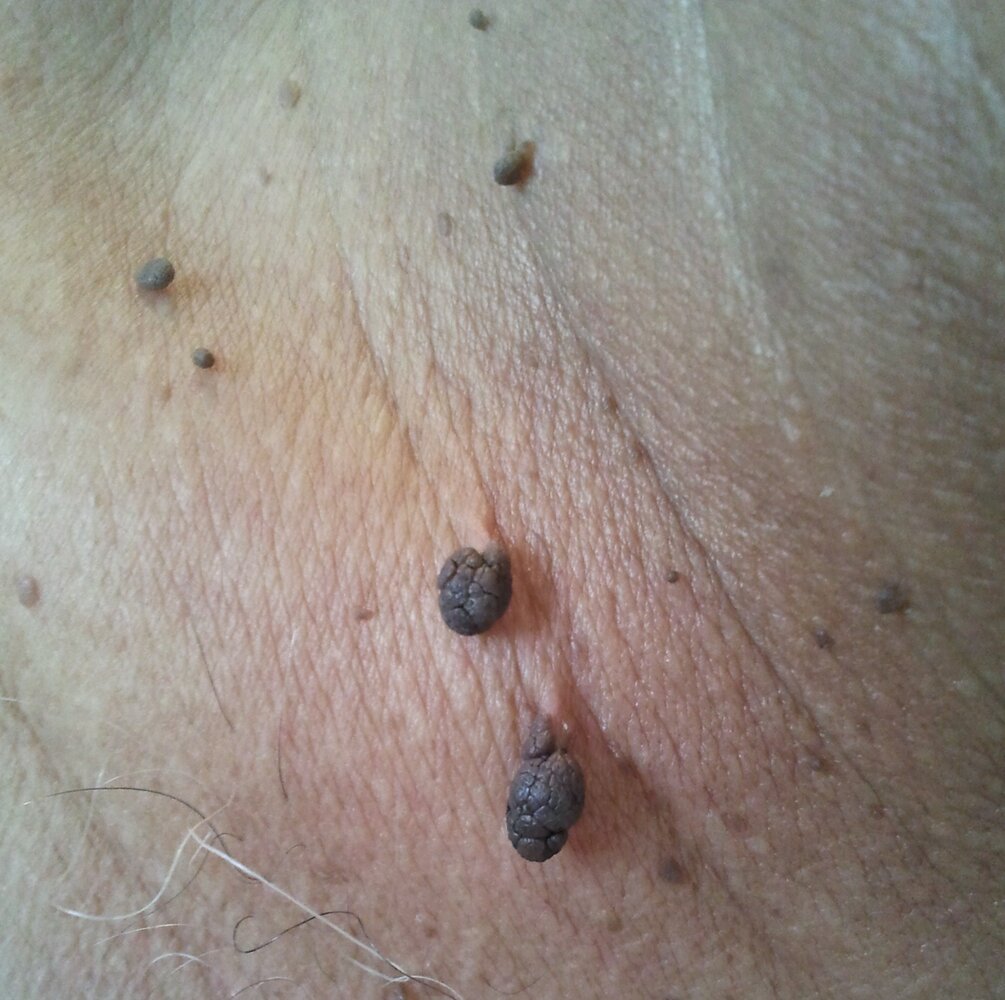 Acrochordons (skin tags)