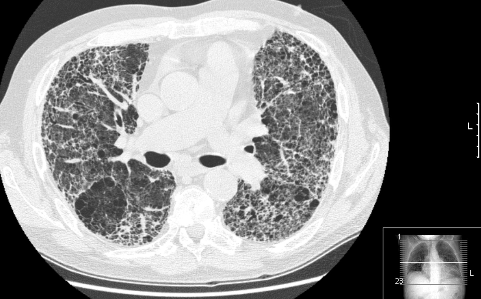 Pulmonary fibrosis