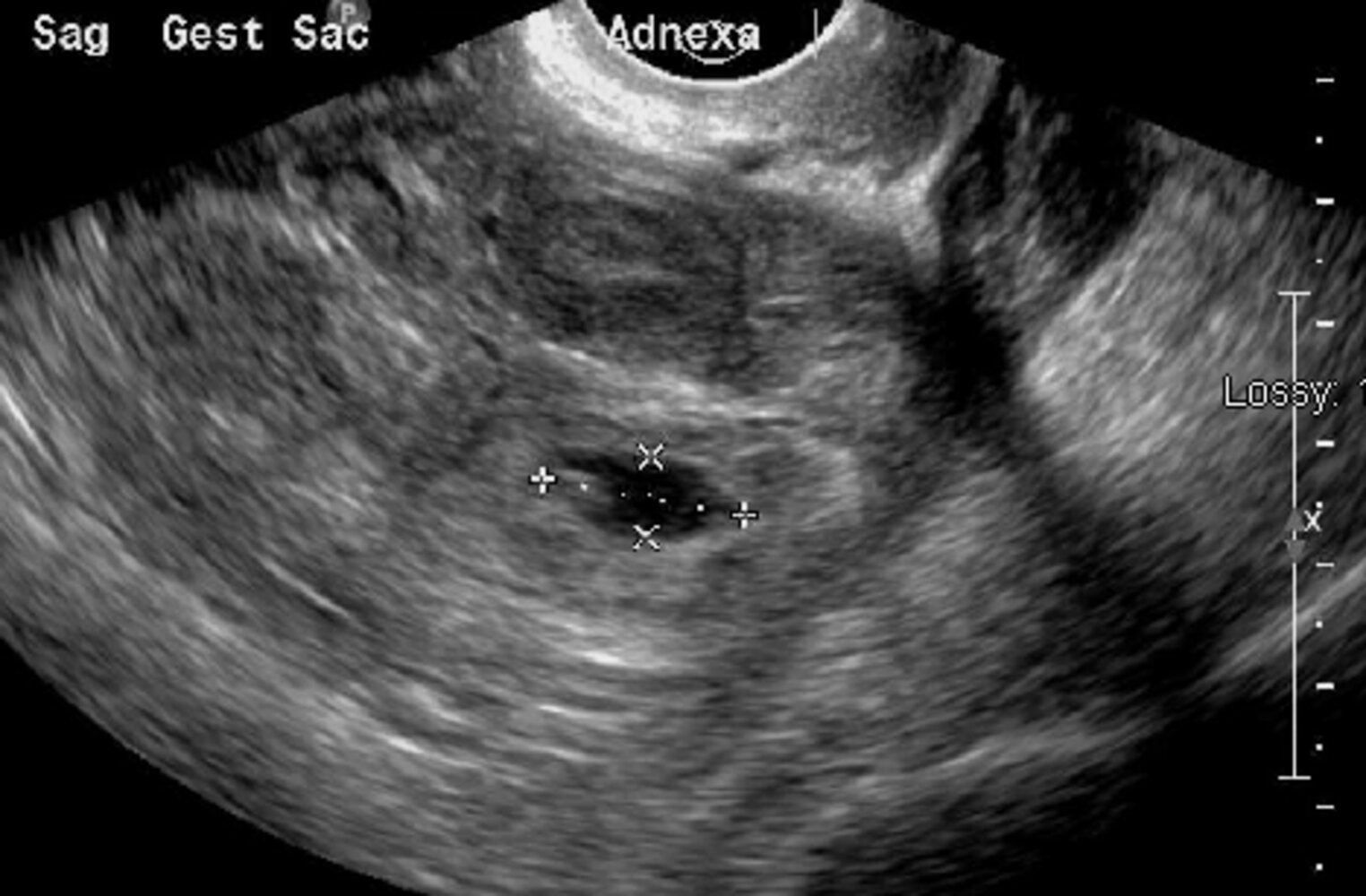 Ectopic pregnancy