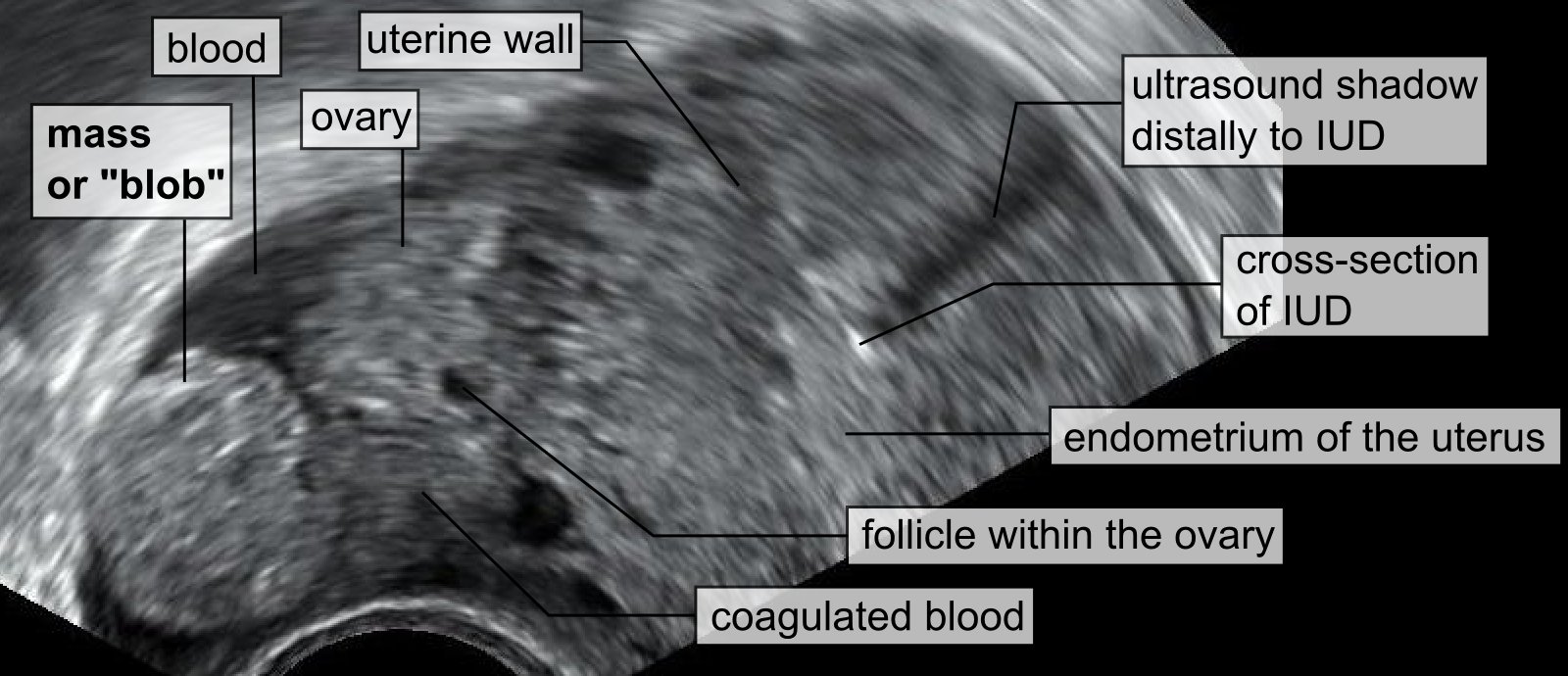 Tubal ring sign (blob sign) of ectopic pregnancy