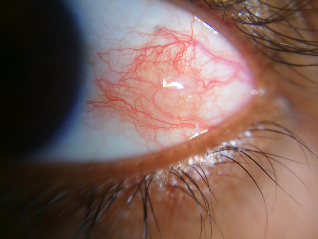 Episcleritis