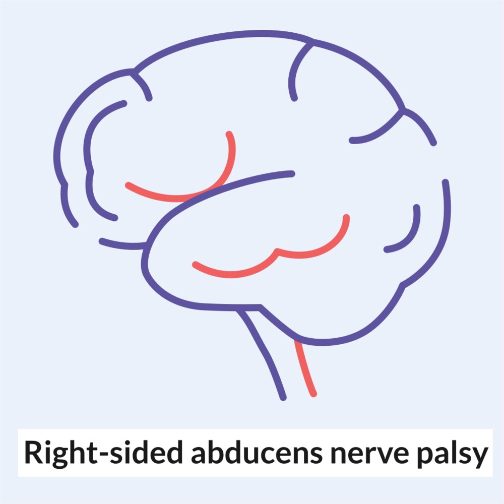 Animation: Right-sided abducens nerve palsy
