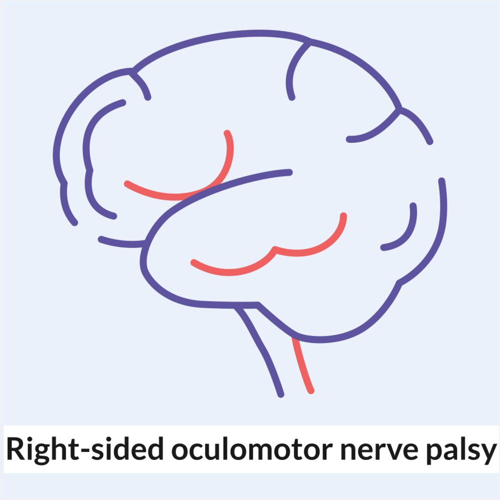 Animation: Right-sided oculomotor nerve palsy