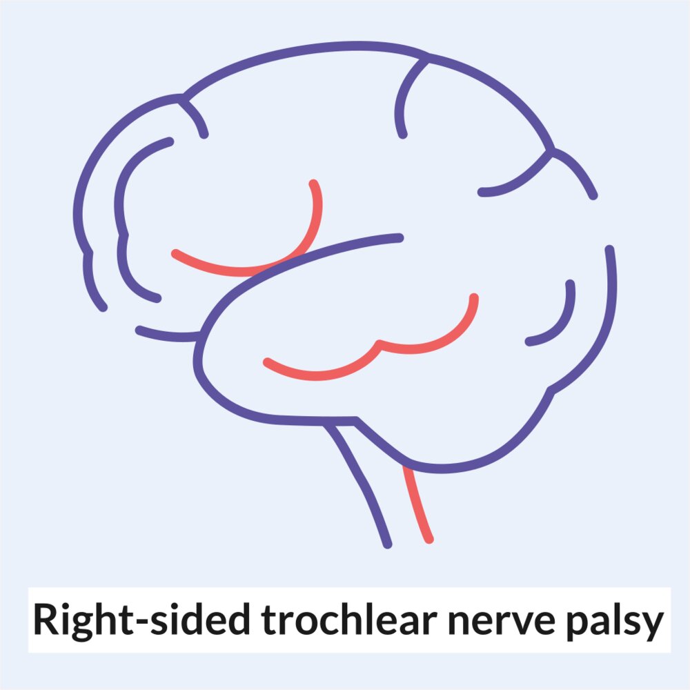 Animation: Right-sided trochlear nerve palsy