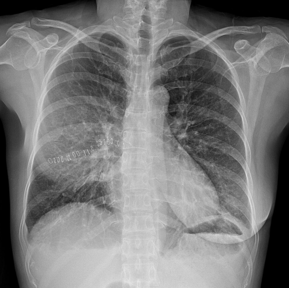 Costophrenic sulcus blunting from pleural effusion