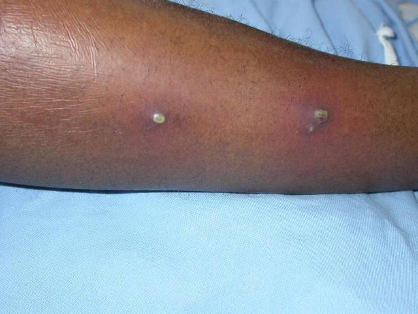 Folliculitis