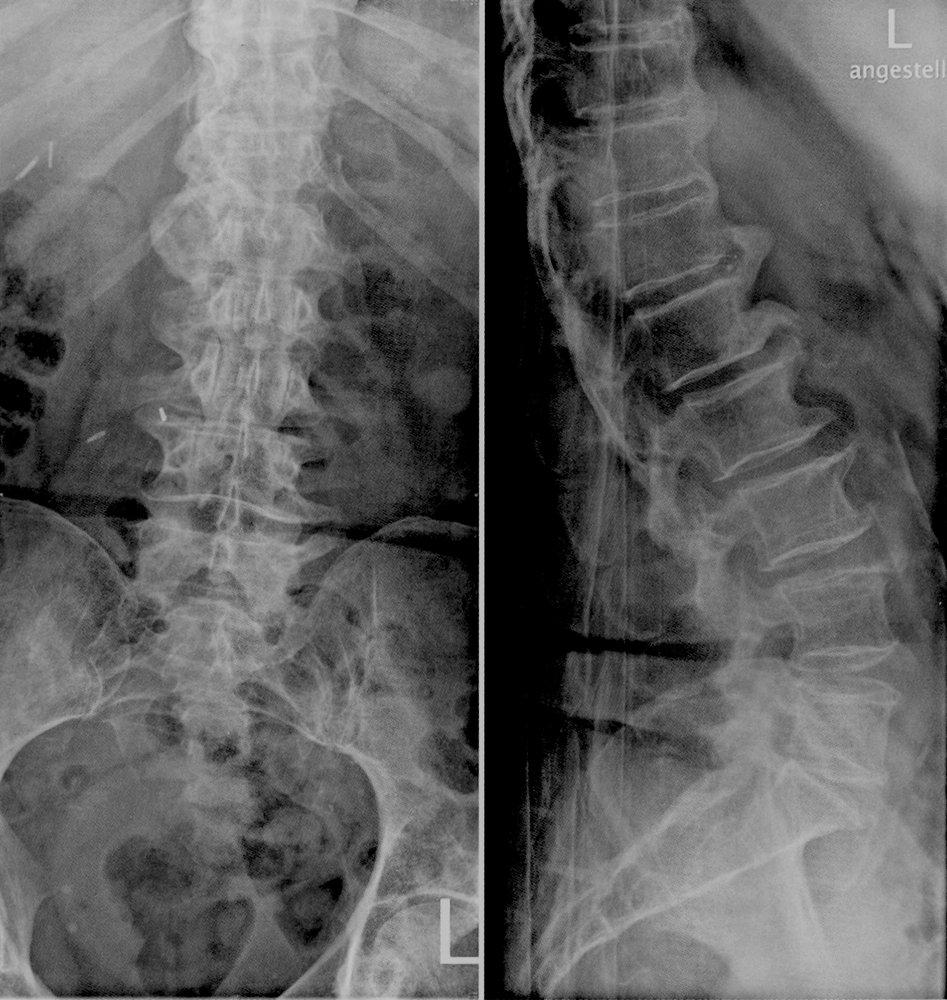 Lumbar spondylosis