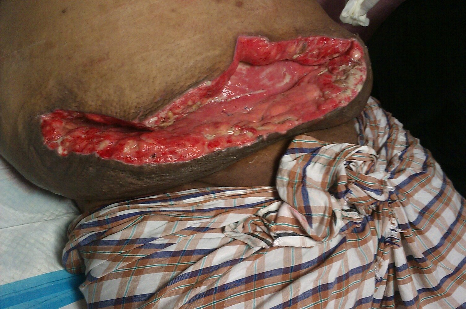 Wound dehiscence after inguinal hernia repair