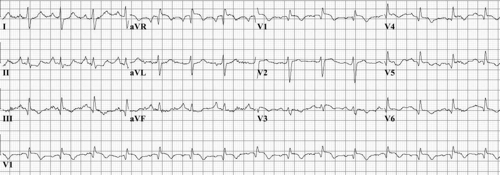 ECG of a patient with pulmonary embolism