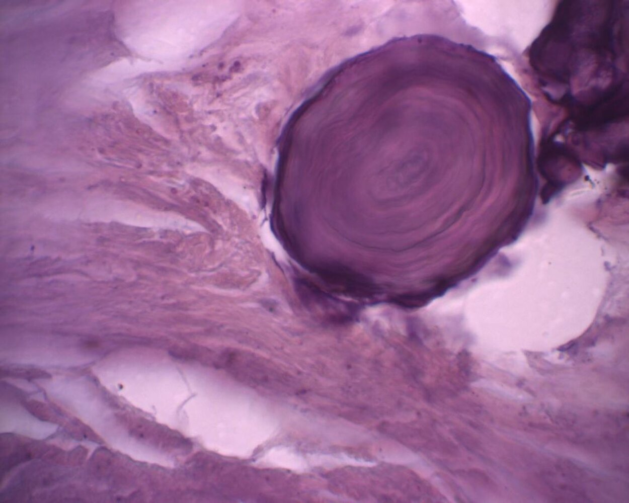 Psammoma body