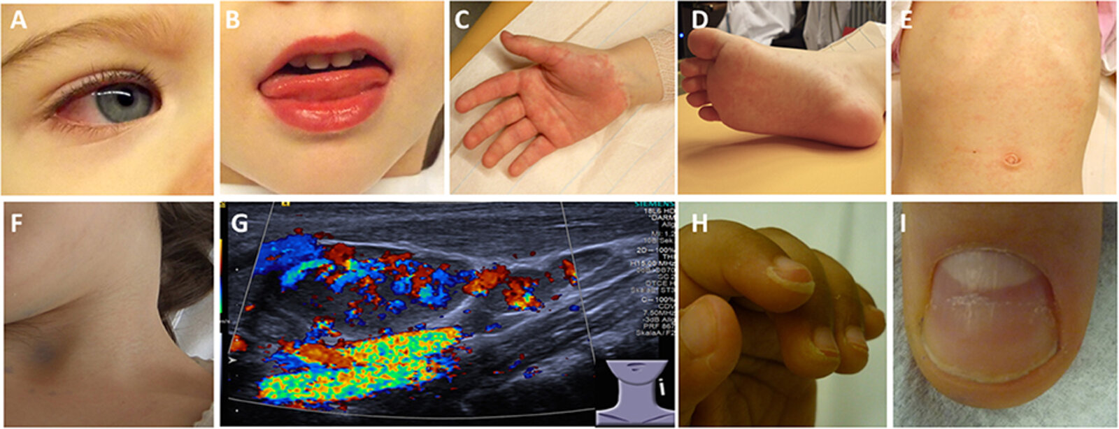 Typical findings in Kawasaki disease