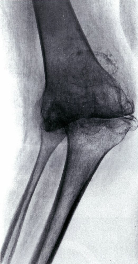 Knee joint destruction in rheumatoid arthritis