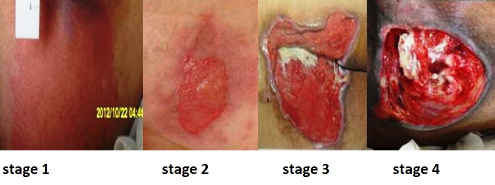 Stages of decubitus ulcers
