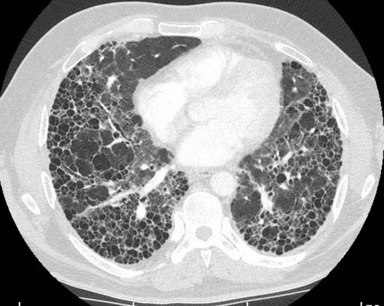 Pulmonary fibrosis from occupational exposure