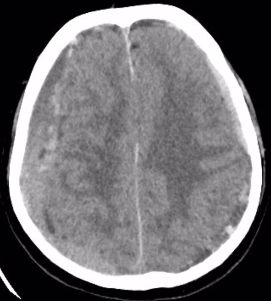 Bilateral subdural hematomas