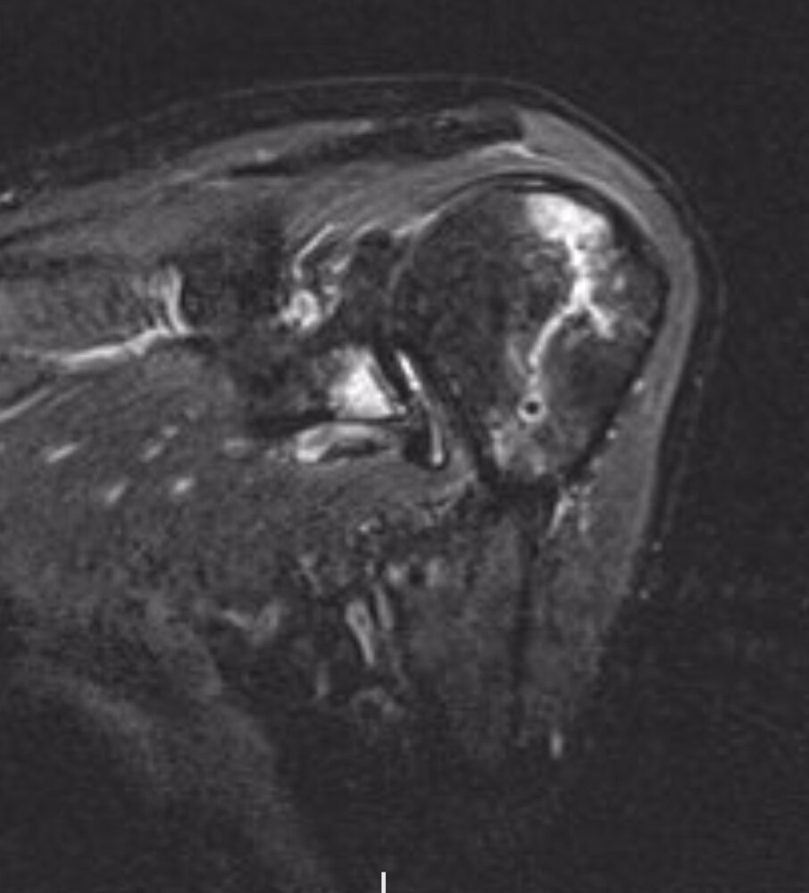 Anterior shoulder dislocation