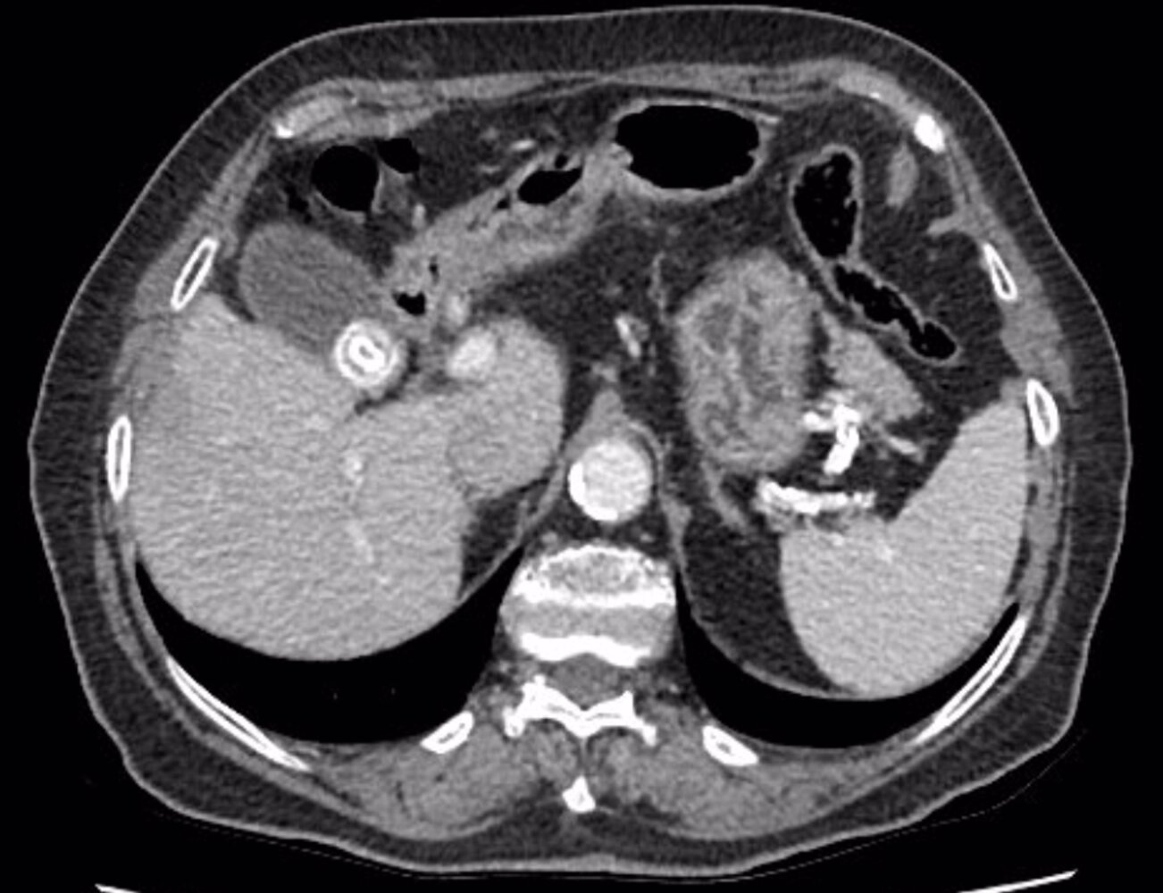 Cholelithiasis and choledocholithiasis