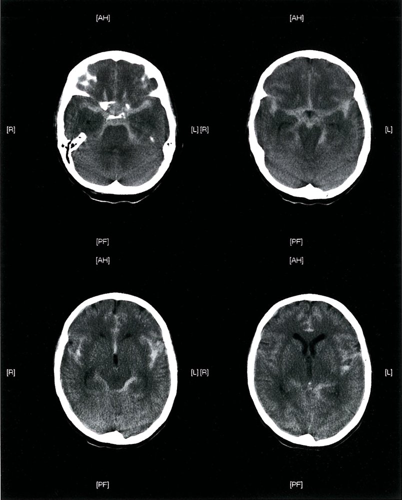 Subarachnoid hemorrhage